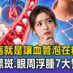糖尿病就是「讓血管泡在糖水裡」！脖子黑斑、眼周浮腫「7大身體警訊曝」【57健康同學會】