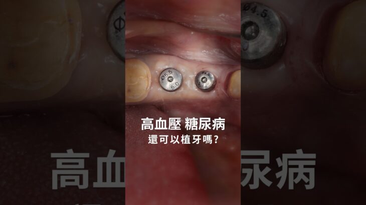 有高血壓、糖尿病，還可以植牙嗎【祐民牙醫－隱適美旗艦店】許文斌醫師（大許醫師） #高血壓#糖尿病#骨質疏鬆#植牙