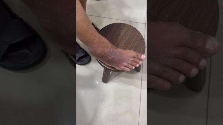 肝腎功能不好 體內排毒功能變差 引起糖尿病、慢性腎臟病 、高血酯症、高血壓、高尿酸血症 都會引起體質變酸性 （正常是弱鹼性）常會引起全身蕁麻疹 全身癢 紅疹 下肢血管炎 色素沉著 261005