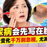 糖尿病藏不住？脸上出现这5个信号别轻视发现晚了才后悔#糖尿病 #血糖 #控血糖 #胰岛素抵抗 #黑棘皮病 #黑脖子 #血糖异常 #血糖高 #糖尿病信号