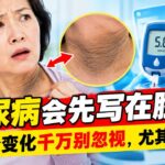 糖尿病藏不住？脸上出现这5个信号别轻视发现晚了才后悔#糖尿病 #血糖 #控血糖 #胰岛素抵抗 #黑棘皮病 #黑脖子 #血糖异常 #血糖高 #糖尿病信号