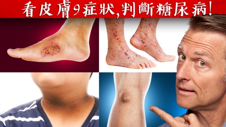 【皮膚】皮膚9症狀, 判斷糖尿病,降血糖自然療法,柏格醫生 Dr Berg