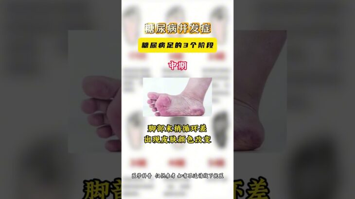 糖尿病併發症——糖尿病足的三個階段 #糖尿病併發症 #糖尿病足 #健康使用計劃