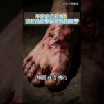 剪破点皮就要锯掉整只脚？糖尿病足不是吓唬人，高血糖正在脚底埋雷 #健康养生 #健康饮食 #控糖 #糖尿病足 #糖尿病并发症
