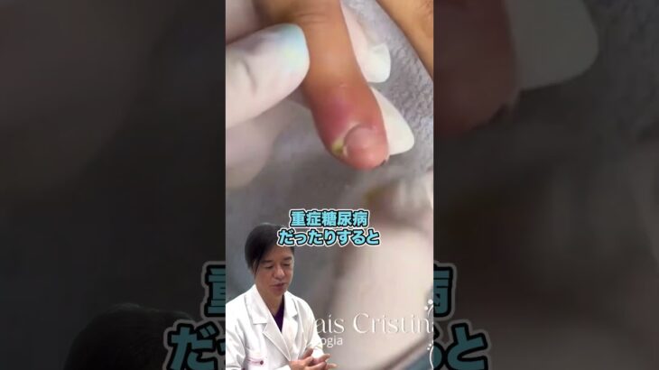 【爪囲炎】重症糖尿病の人は特に注意！手の指にできたパンパンに腫れた箇所の排膿処置！
